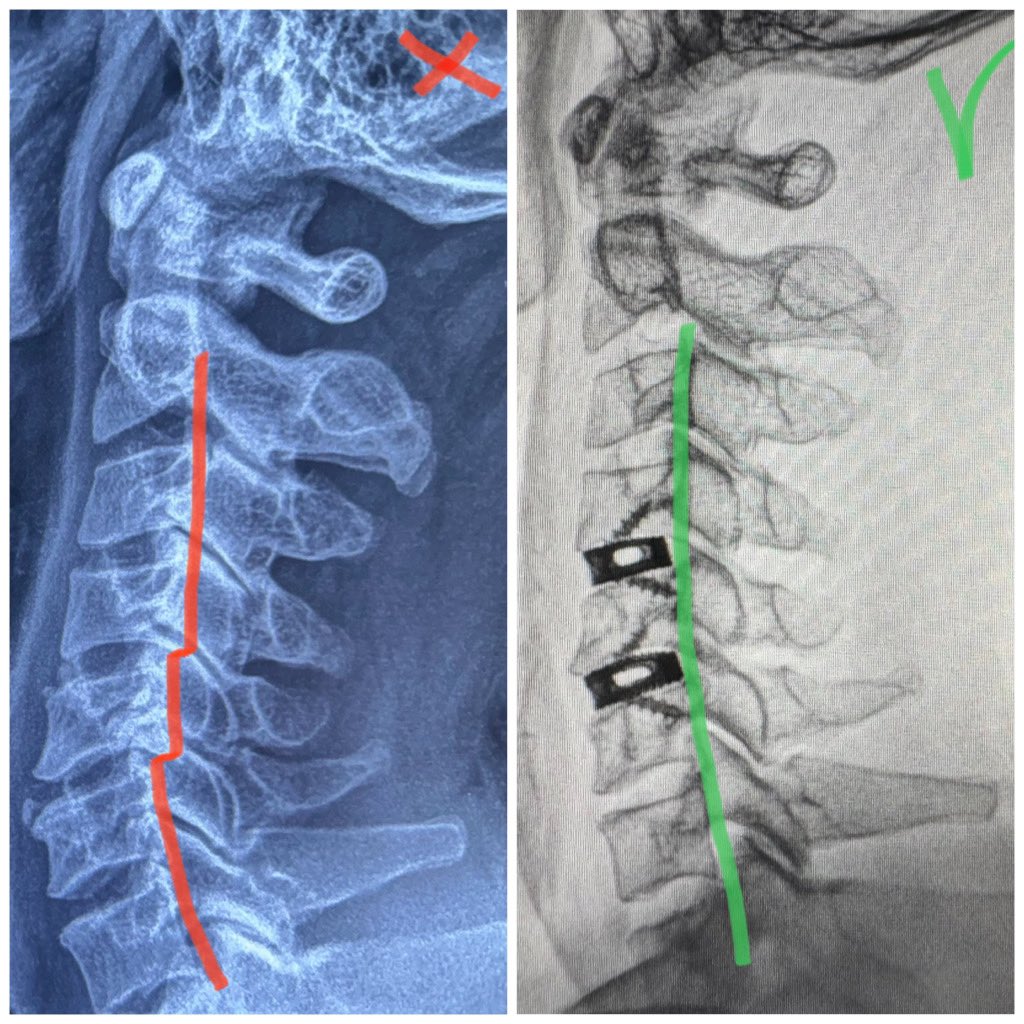 pterion77's tweet photo. Pte con cervicobraquialgia ,hernia discal  y listesis C4-5 y C5-C6 fue llevado a cx Descompresion , estabilización y restauración de la lordosis,alta al siguiente día, @pablopenatapia  @HospitaldelRio #cervicalspine #columnavertebral #colunavertebral #spine #acdfsurgery https://t.co/xBUvUBnh8h