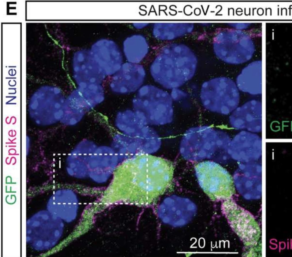 1/🧵Fusion of Neurons in COVID
 
🔹At 2 yrs many #LongCOVID pts still suffer 🧠
🔹We’re beginning to  understand why
🔹“Fusogens” activated by viruses like COVID can create irreversible cell-to-cell damage & miscommunication

Pic = Spike infected neuron

Link in Tw 3