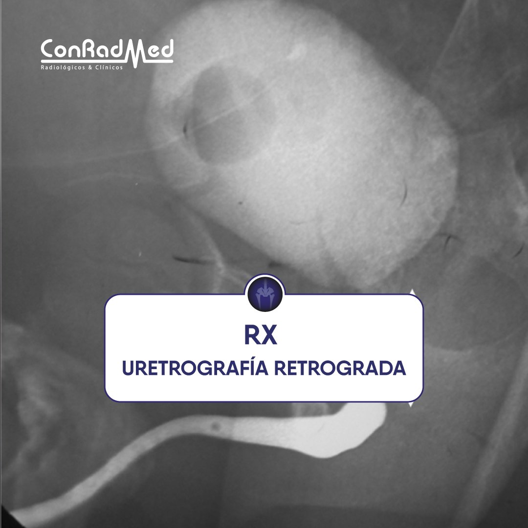 ConRadMed's tweet image. Realiza un procedimiento radiológico de rutina para verificar la integridad de la uretra.
No olvides que puedes agendar:
Vía WhatsApp: bit.ly/3vy8V1c
Teléfonos: 99 88 84 74 01 | 99 88 84 73 88