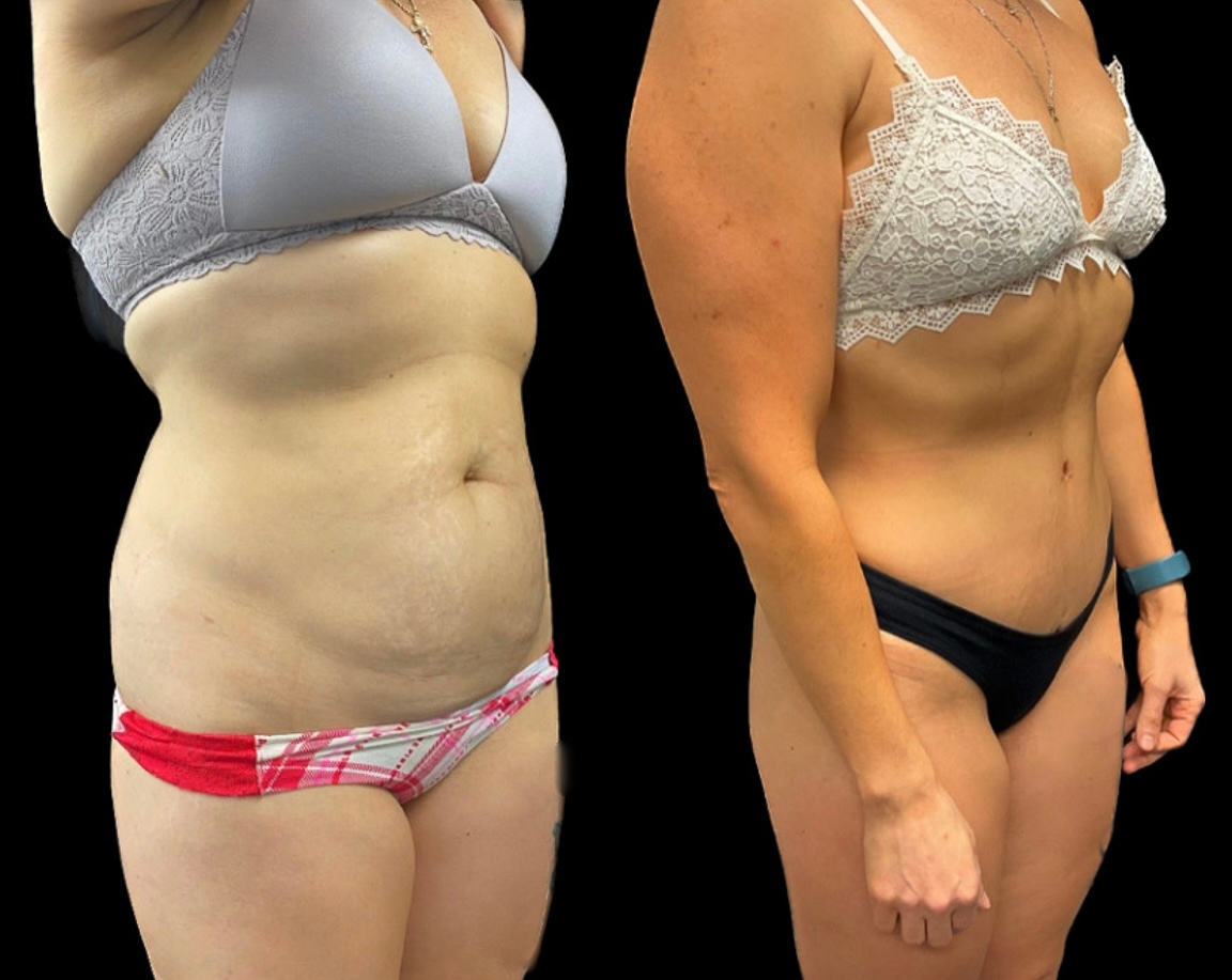 Tummy Tuck 
📸Shared with patient permission⁠
📞 Phone: 716.821.2935⁠
🖥️ Website: buffaloplasticsurgery.com⁠
📍 Location: Buffalo, New York⁠
💤Anesthesia: general⁠
.
#buffaloplasticsurgery #boardcertifiedplasticsurgeon #plasticsurgery #buffalo #tummytuck #bellybutton