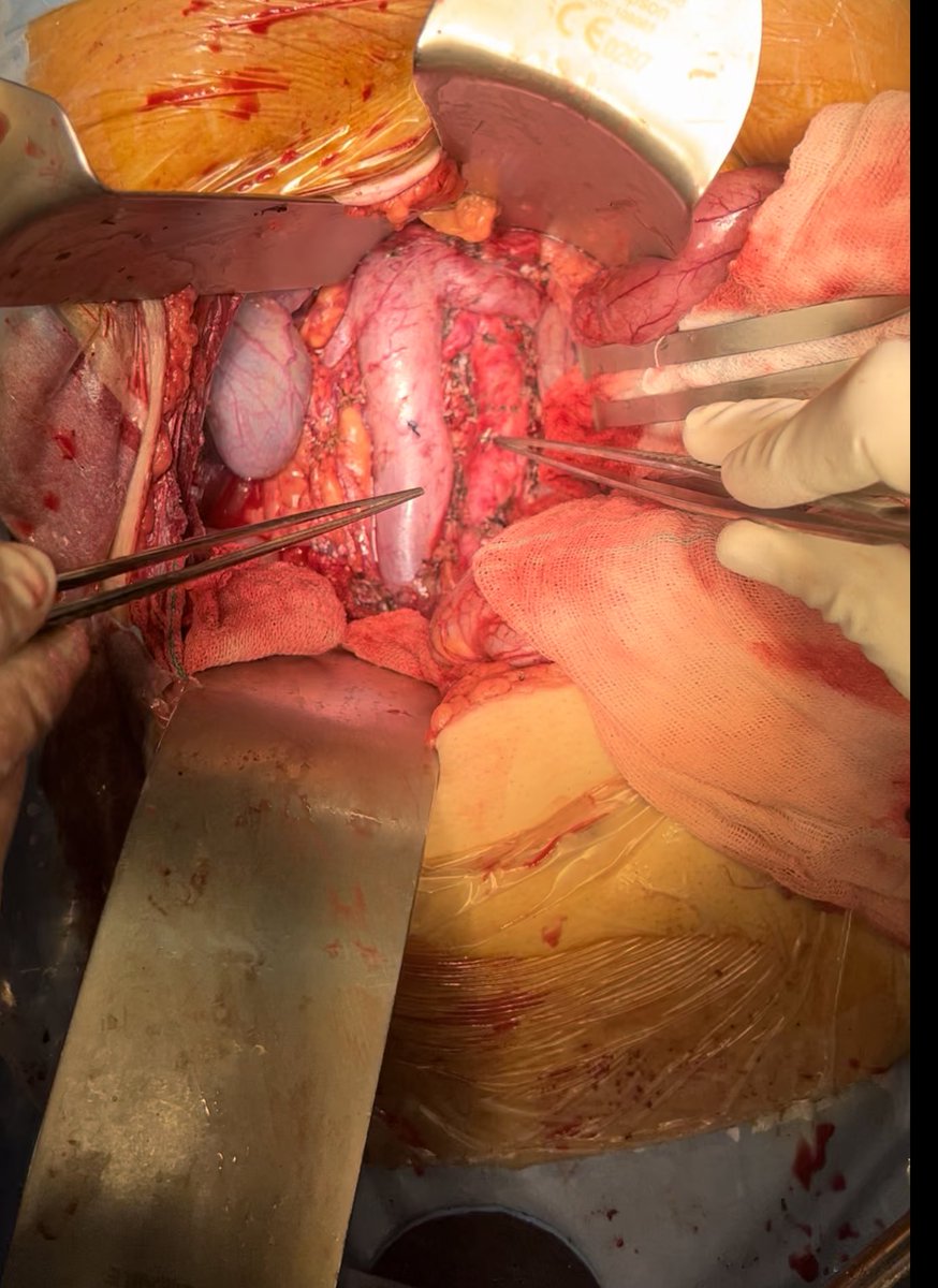 #anatomy 
Renal veins 
Right renal artery