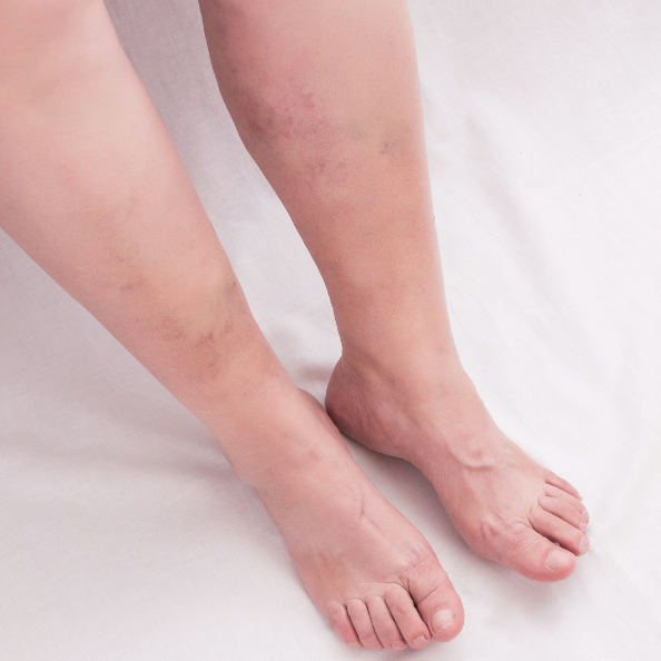 It is #LegsMatterWeek and we have a factsheet “looking after your legs” developed by clinicians and our people's panel which has do's and don’ts and red flag symptoms. #selfcareforlife. bit.ly/2tiBs9K <a href="/nursedibdob/">💙 Debbie Wickens 💙</a> <a href="/Pauline_Nurse_1/">Pauline Robinson 💙</a> @ClareMorrisWCP <a href="/LegsMatter/">LegsMatter</a> @rhianlast