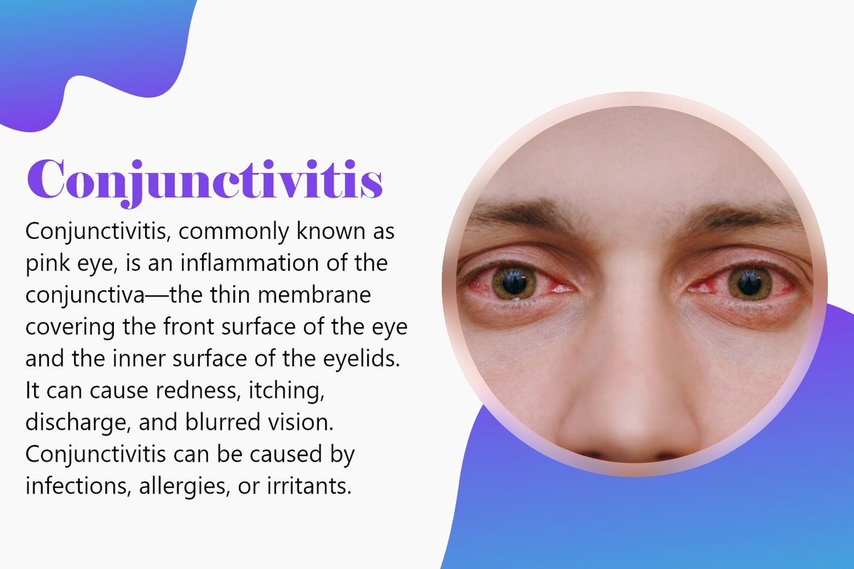 Conjunctivitis is an eye condition caused by infection or allergies.
#Conjunctivitis #DiseasePreventionTips #HealthForEveryone #PreventiveHealth #HealthAndFitness #HealthyChoices #WellnessCommunity #KnowYourHealth #HealthIsWealth #SupportAndPrevention 
umbrellamd.com