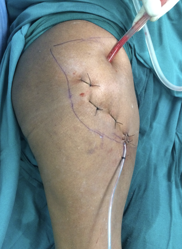 centerofhip's tweet image. Percutaneous quilting is a simple but very useful technique in  large Morel-Lavalle lesions like these. Addresses the primary pathology. 
Mark out the boundary of the lesion first using a suction tip. Then apply sutures using 1 ethilon  or similar from periphery to centre.  1/2
