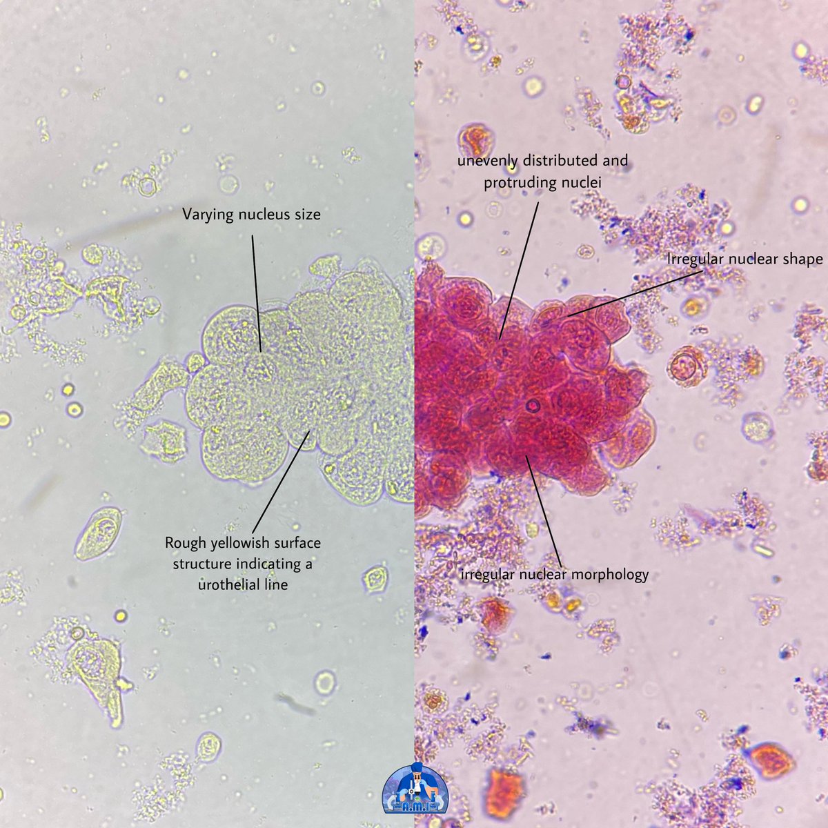 Urothelial cancer cells , papillary cluster #urine_sediment #urinarysediment #urothelial