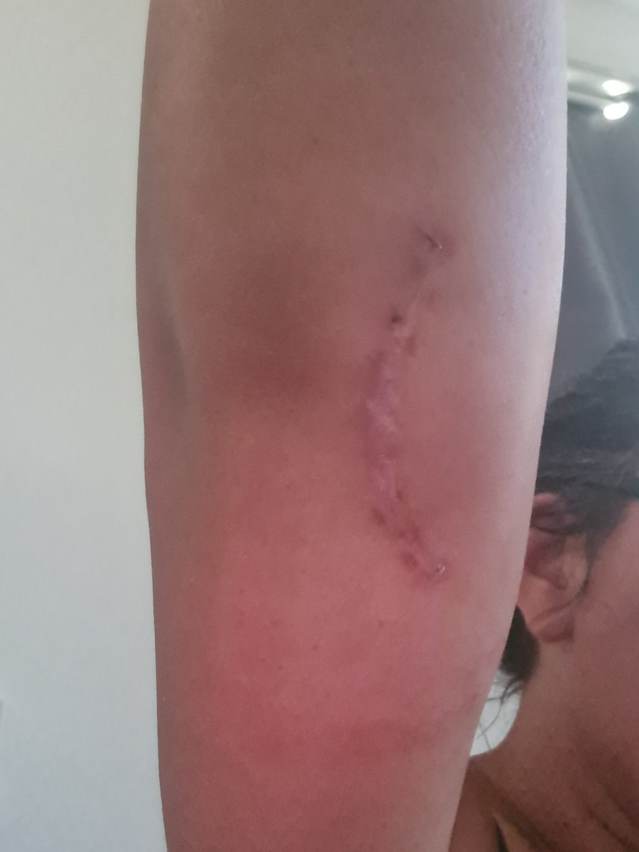 Pleurtje's tweet photo. Post Cubital Tunnel Syndrome, never in a million years, did I expect this outcome, after seeing the scar the first time #OneMonthLater Okay still can't use my arm properly, but there is improvement, no strength but definitely less nerve pain 🔥 https://t.co/rh1zTJ1jFF