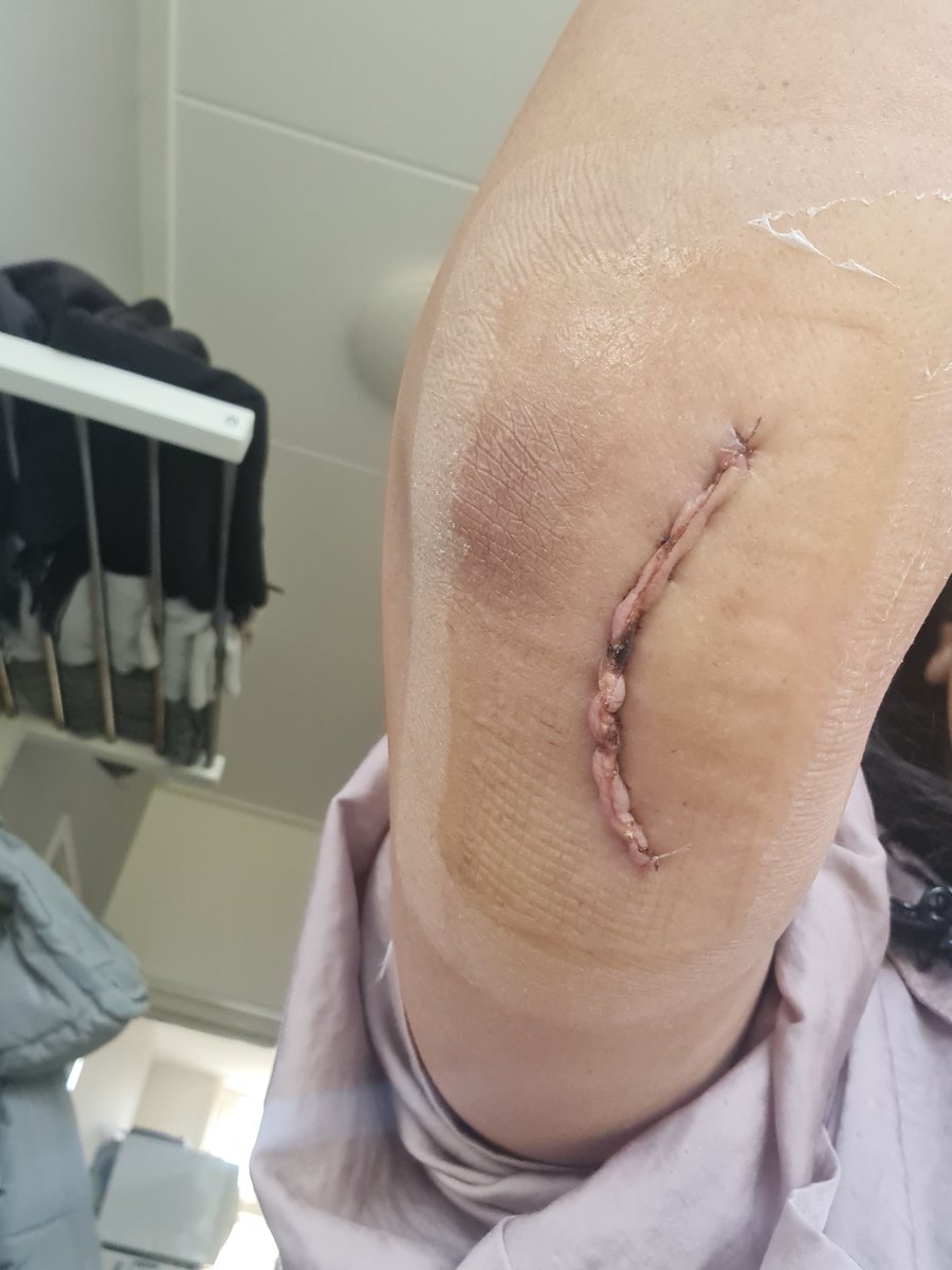 Pleurtje's tweet photo. Post Cubital Tunnel Syndrome, never in a million years, did I expect this outcome, after seeing the scar the first time #OneMonthLater Okay still can't use my arm properly, but there is improvement, no strength but definitely less nerve pain 🔥 https://t.co/rh1zTJ1jFF