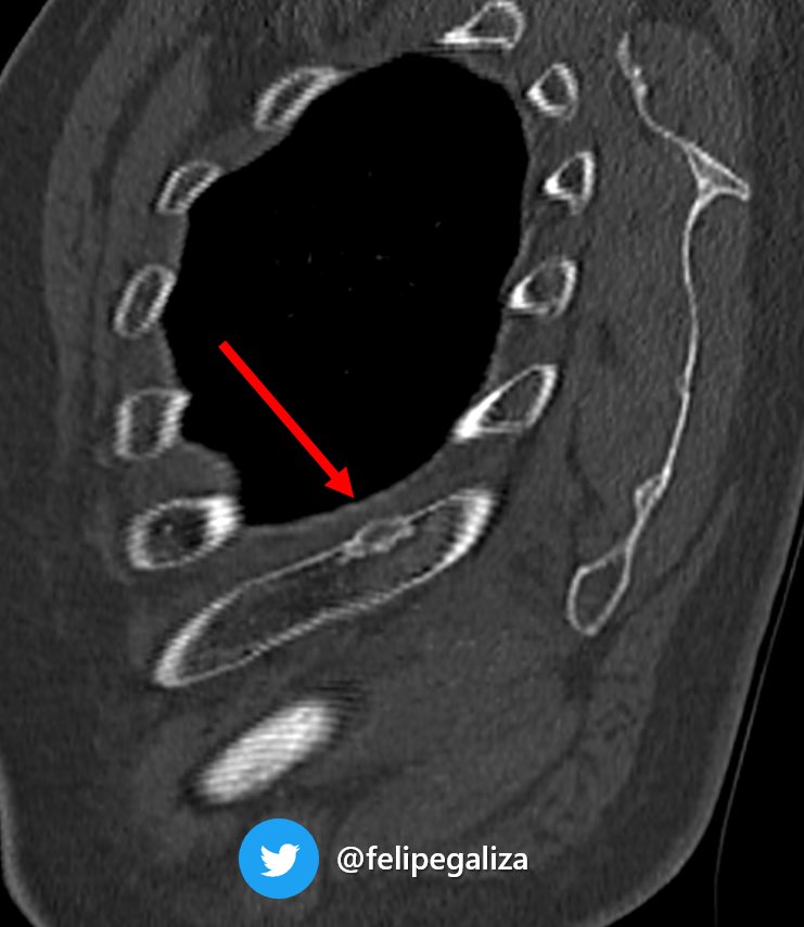 🫤Typical PSMA Pitfall 

61yo w/ BCR of Prostate ca 
PSA 0,4 after a rib SBRT and increasing PSA (based on abroad PET)

☢️PSMA-PET: mild uptake rib lytic lesion w/ sclerotic rim 

🔬benign lesion (probable Fibrous cortical defect)

⚠️the most common pitfall⚠️

#radres #FOAMrad