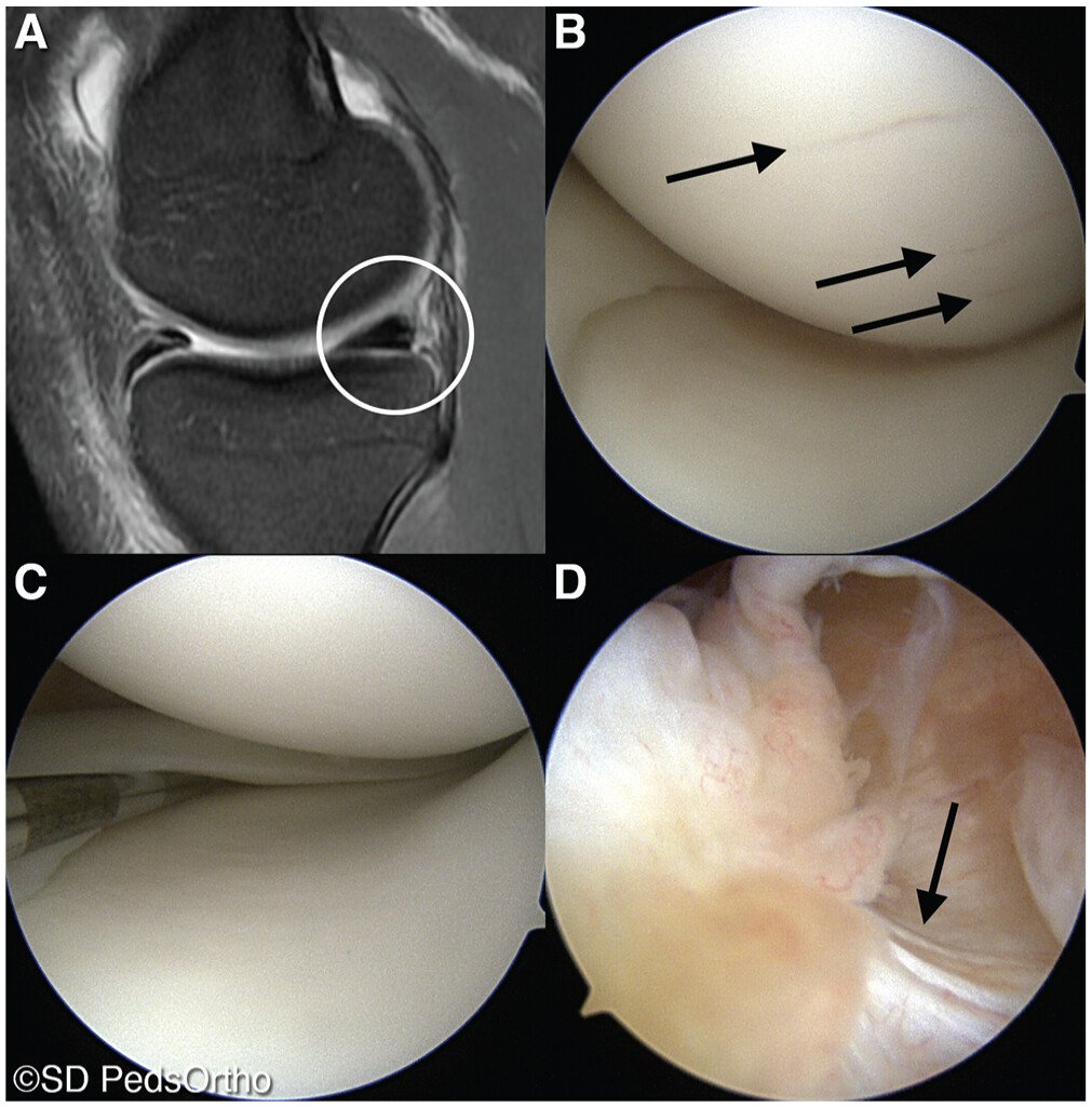 aossmjournals's tweet photo. In adolescents undergoing #ACL reconstruction, medial femoral condyle #chondromalacia during arthroscopy and posteromedial tibial marrow edema on #MRI are evidence of a #RampLesion #teamrady #radychildrenshospital
https://t.co/ENcaUjpWWx https://t.co/57jWCZjQ6N