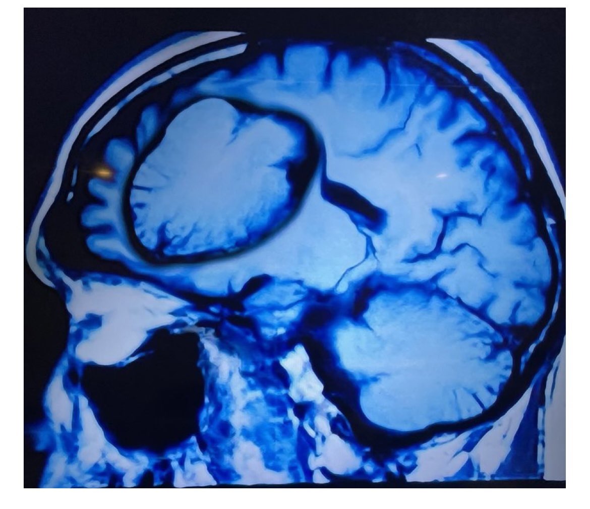 OGdukeneurosurg's tweet image. Case of the ectopic redundant cerebellum