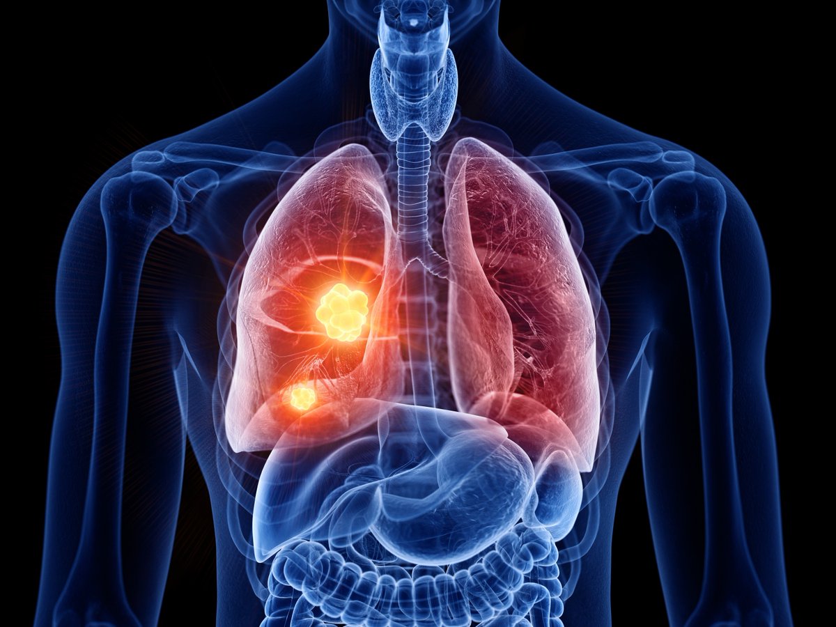 Mass General researchers summarized findings on #lungcancer in patients w/ interstitial lung disease (ILD), including considerations for diagnosing and treating lung cancer in that population and monitoring for ILD progression during lung cancer treatment. spklr.io/6014Yxvw