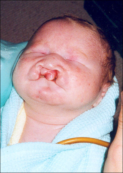 unblogmedico's tweet photo. 🏥 ¿La siguiente presentación clinica es caracteristica de que patología? 

▫️ Recien nacido con labio hendido/paladar hendido
▫️ Holoprosencefalia o microcefalia
▫️ Polidactilia
▫️ Aplasia cutis https://t.co/HY1pUVsqlN