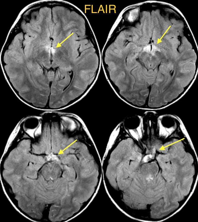 daniel_gewolb's tweet image. Lyme disease (Lyme neuroborreliosis) in this child w/ eye pain, progressive worsening blurry vision, decreased color perception, fatigue, and low grade fever

Case confirmed on Western blot following a positive Lyme C6

#ophthalmology #Neurology #neurosurgery #neurotwitter #meded