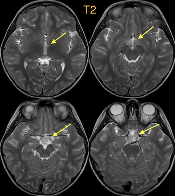 daniel_gewolb's tweet image. Lyme disease (Lyme neuroborreliosis) in this child w/ eye pain, progressive worsening blurry vision, decreased color perception, fatigue, and low grade fever

Case confirmed on Western blot following a positive Lyme C6

#ophthalmology #Neurology #neurosurgery #neurotwitter #meded