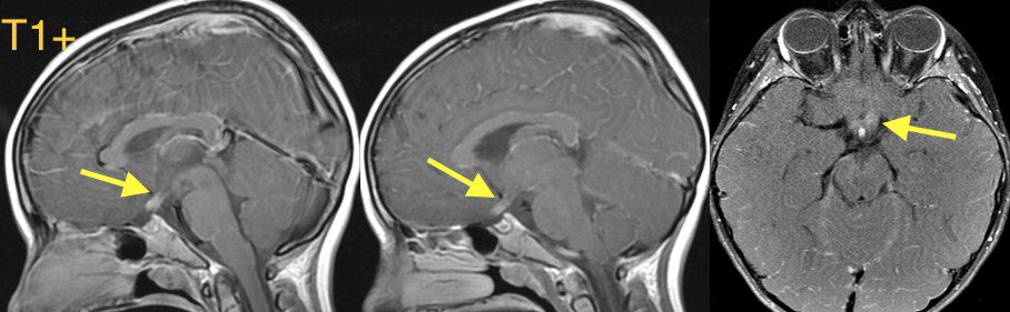 daniel_gewolb's tweet image. Lyme disease (Lyme neuroborreliosis) in this child w/ eye pain, progressive worsening blurry vision, decreased color perception, fatigue, and low grade fever

Case confirmed on Western blot following a positive Lyme C6

#ophthalmology #Neurology #neurosurgery #neurotwitter #meded