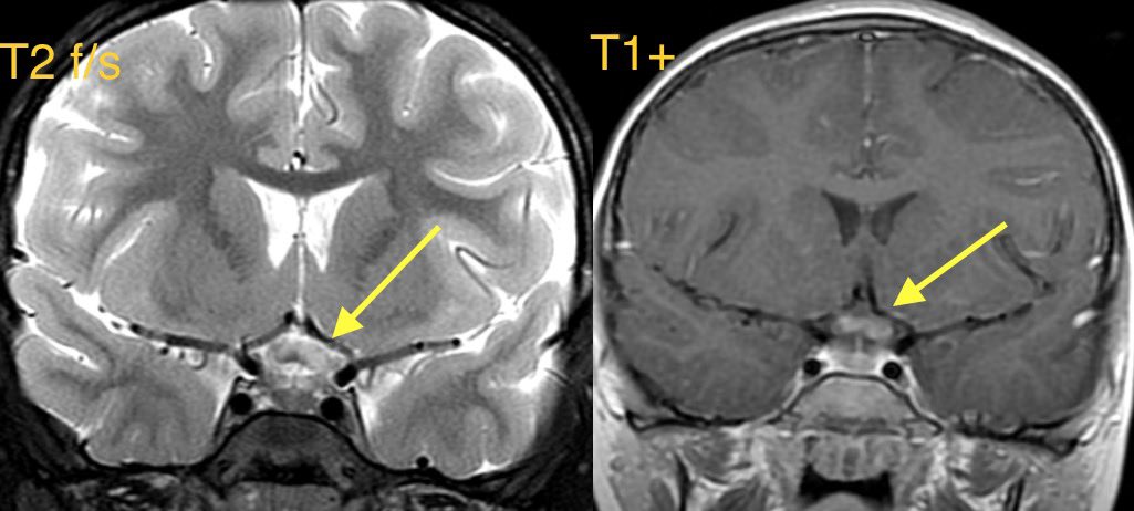 daniel_gewolb's tweet image. Lyme disease (Lyme neuroborreliosis) in this child w/ eye pain, progressive worsening blurry vision, decreased color perception, fatigue, and low grade fever

Case confirmed on Western blot following a positive Lyme C6

#ophthalmology #Neurology #neurosurgery #neurotwitter #meded