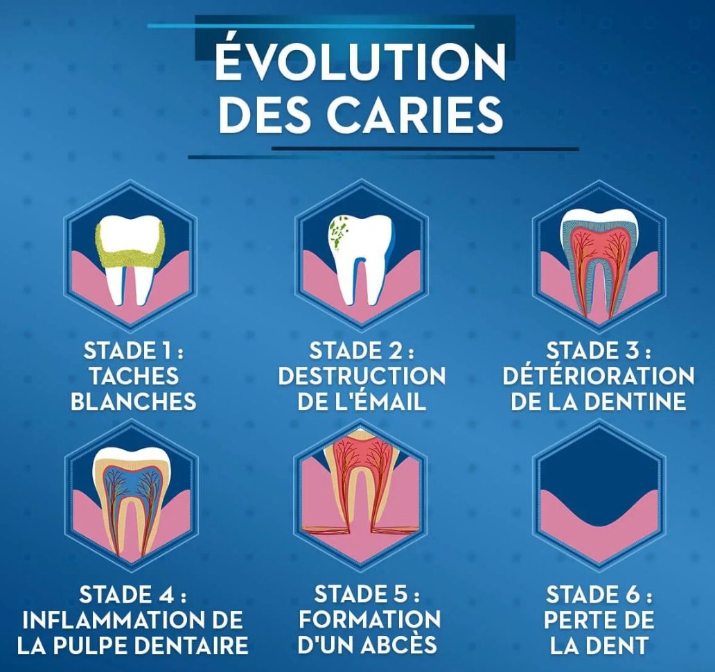 sms_dent's tweet photo. La carie dentaire, est une maladie infectieuse de la dent, qui se manifeste par une lésion de l'émail, du cément ou de la dentine, voir même de la pulpe.

avec @sms_dent souriez en toute confiance https://t.co/gTlPZ8gIEG