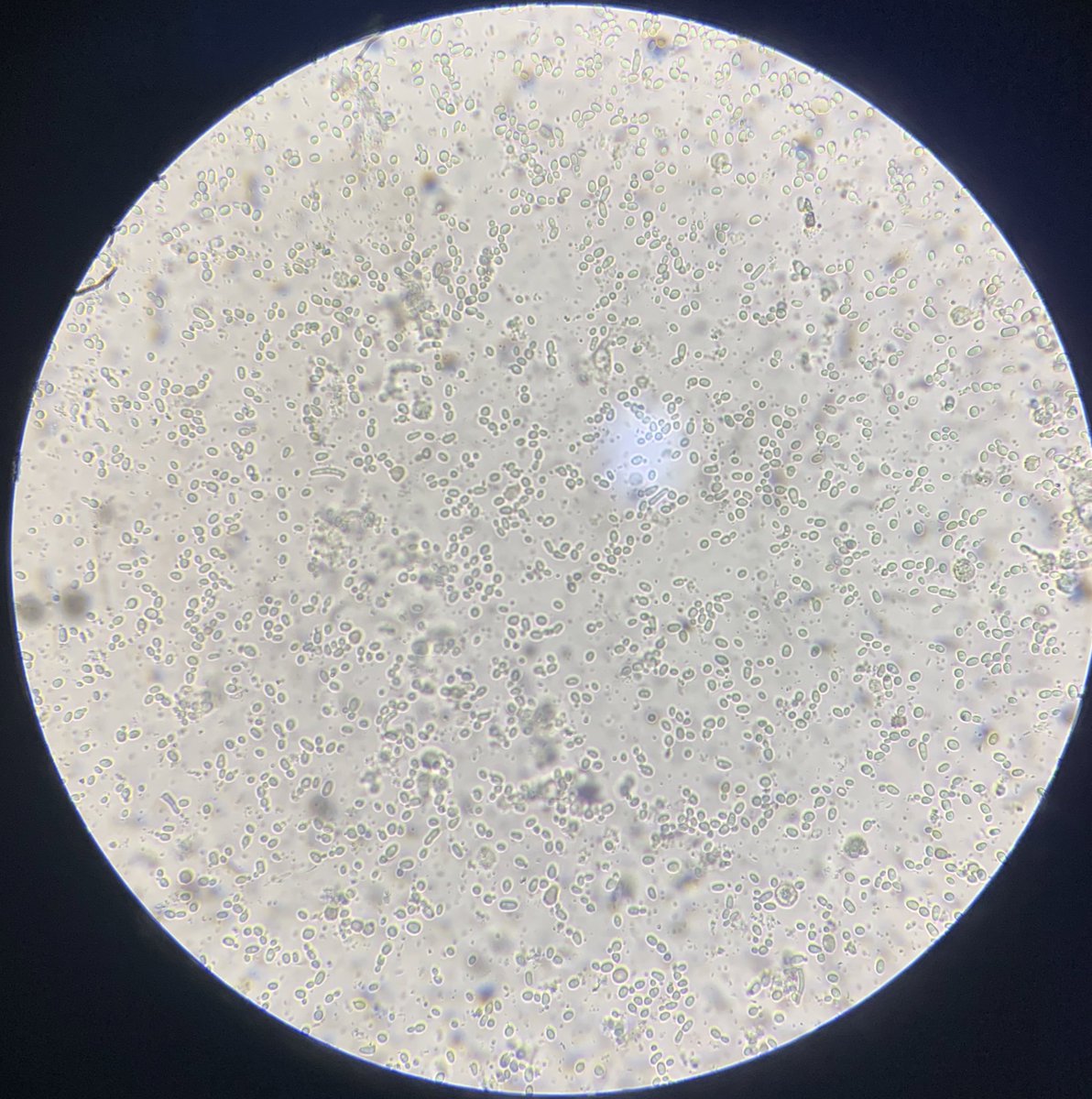 The yeast cells in this Urine Microscopy sha!