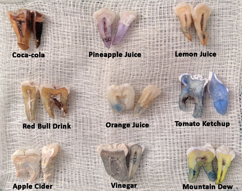 Soaking sectioned teeth in different acidic beverages

Which one do you think had the strongest demineralization effect?

(PS Ketchup didn’t turn the tooth blue, it was from the labeling ink)