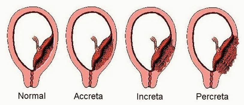 nebulinamx's tweet photo. Acretismo placentario: 
Placenta acreta: alcanza el miometrio 
Placenta increta: Invade el miometrio
Placenta percreta: Penetra el miometrio https://t.co/cfnMoXuAml