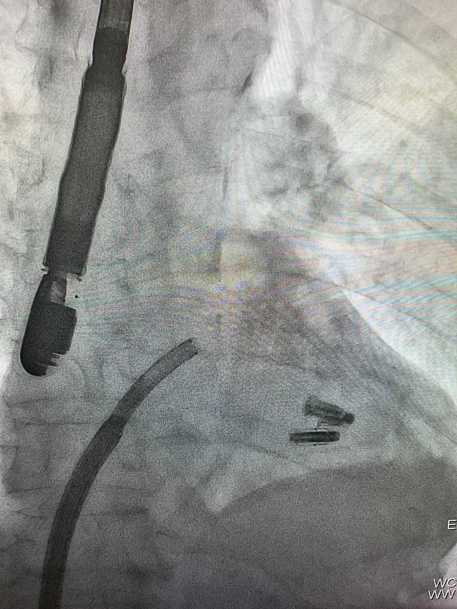 Congratulations to the Structural Heart Team at @christianacare for successfully completing Delaware’s first @EdwardsLifesci PASCAL Precision Transcatheter Valve Repair System for Degenerative Mitral Regurgitation case. We now offer this cutting-edge technology in Delaware!!