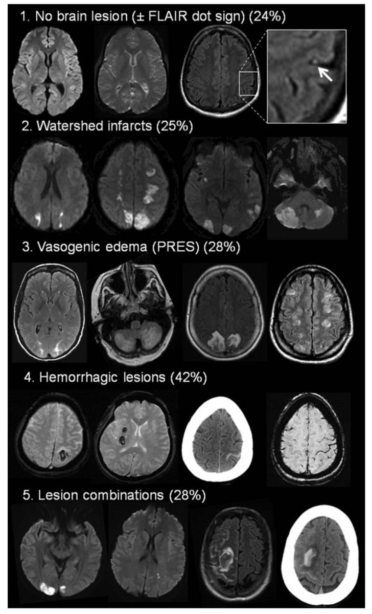 WorldStrokeEd's tweet image. #MondayTip
 
1/2 Different lesion patterns in Reversible Cerebral Vasoconstriction Syndrome #RCVS
 
⏺️ No lesion (+/-Flair dot sign)
💦 Watershed
🌊Vasogenic Edema
🩸Hemorrhage
🖇️Combinations

onlinelibrary.wiley.com/doi/pdf/10.100…