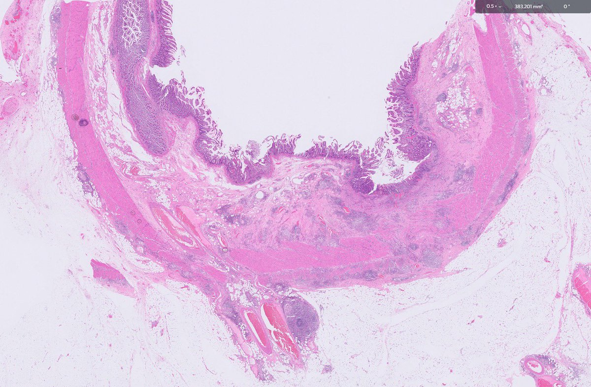 Adhesions! What’s is the cause 

Can you tell from low power ?

#GIpath #gitpath #PathTwitter #pathology #pathologyfamily