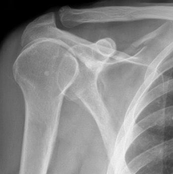 Where is the abnormality?  Diagnosis?  This xray is not normal. (Source: J of Urgent Care)