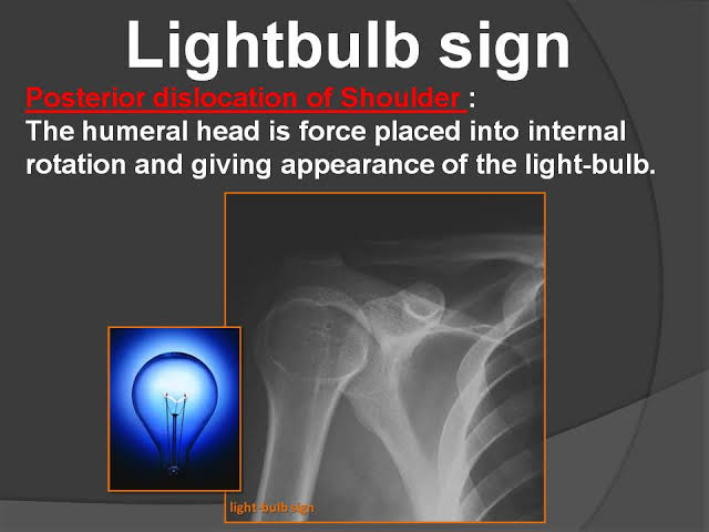 <a href="/radRounds/">radRounds Radiology Network</a> Light bulb 💡 sign.
Posterior dislocation of shoulder