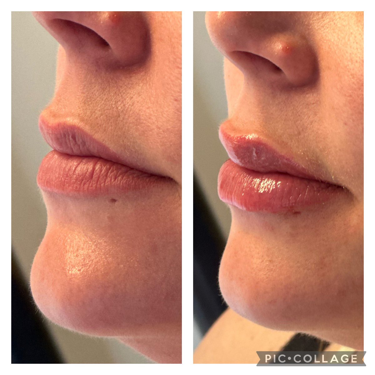 Lips are life! 💜💜 1.1ml £180 #lipsarelife #sevenoaksmums #carleycaesthetics #sevenoaksbeauty #tunbridgewellsbeauty #tunbridgewellsmums