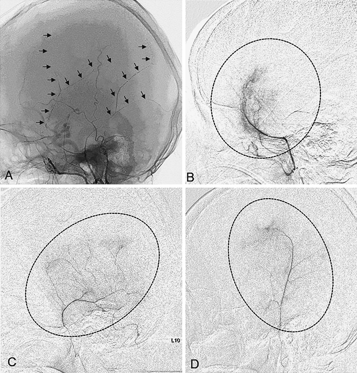 New Arrival: Extensive Roles and Technical Advances of Middle Meningeal Artery Embolization for Chronic Subdural Hematoma
doi.org/10.2176/jns-nm…
#Trauma #MiddleMeningealArteryEmbolization #ChronicSubduralHematoma