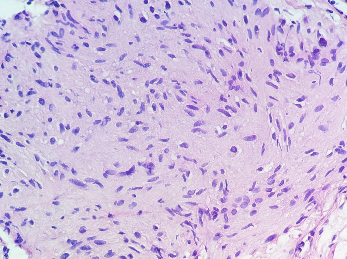 @IHC_guy  @stephen_lagana @emma_furth @RAStandish 
#GIpath #PathTwitter 
Lucky bite-in-bite forceps biopsy revealing duodenal GIST