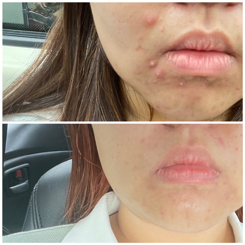 31stoj's tweet photo. ไม่ต้องพูดเยอะ โชว์ผลลัพธ์ให้เห็นกันไปเลย สิวอักเสบตัวมัม #EucerinProAcne Anti Acne Mark Serum เอาอยู่มากๆ คนหน้ามัน เหงื่อเยอะ ใส่หน้ากากก็หมักหมม เป็นสิวเรื้อรัง มีรอยดำ รอยแดง ก็จางลง 🥲🥲ต้องขอบคุณ #EucerinThailand จริงๆ #จบทุกสิวด้วยโปรแอคเน่ #สกินแคร์ #ใช้ดีบอกต่อ https://t.co/C3FmFuJbkC