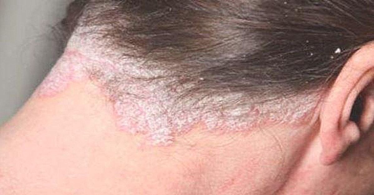 Seboreik Dermatit hastasısınız ve doktor doktor gezmenize rağmen çözüm bulamıyorsunuz muhtemelen. 
Kesin çözümü şöyle: 
Sabah ve akşam, aç karnına 1 çay kaşığı karbonatı 1 bardak suda eritip içiyorsunuz, 2 gün sonra tam şifaya kavuşuyorsunuz!
Tüm mantar enfeksiyonlarında geçerli!