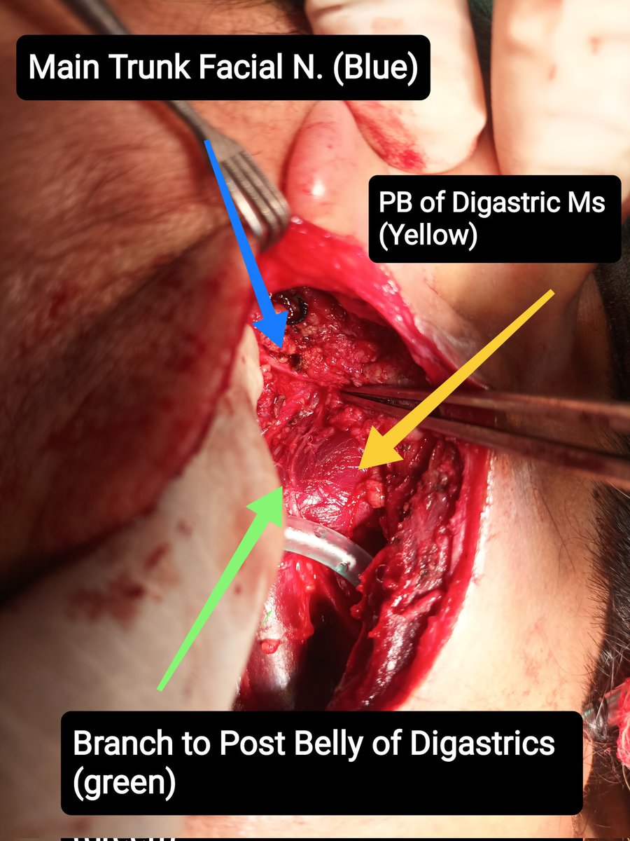 Ent_Faamch's tweet photo. The patient underwent left sided total parotidectomy with Selective Neck Dissection. Post Belly of Digastric helped us in tracing the Facial trunk (retrograde). Post op patient doing well, NO obvious complications noted. https://t.co/5zK6gsZf0o