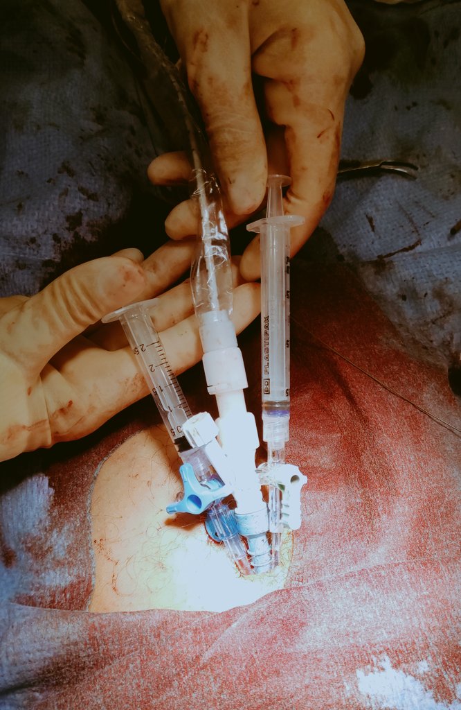 Octavio_JiMelo's tweet image. 💡Improving technique for sterile maintenance of #PercloseSutures in the CCU  @UCC_CHNavarra (using a wire to 🔀 the sideport) #impella
#cathLabhack

Info: youtu.be/tz-dLQ2CO9I
@HadyLichaaMD @pablo_bazal @arantxaechavar @HemodinamicaC  @PCRonline @vruizquevedo @Abiomed