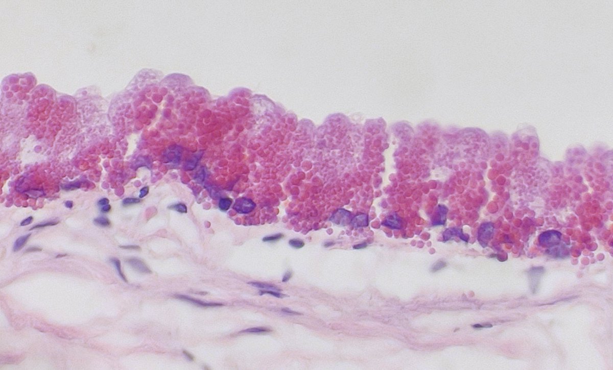 DraEosina's tweet photo. Pink-granular cell change in a gallbladder.
Sometimes biopsies try to cheer you up by being just beautiful 🩷
#GiPath #Pathology #PathArt #Paneth https://t.co/WmTDiTTdi4
