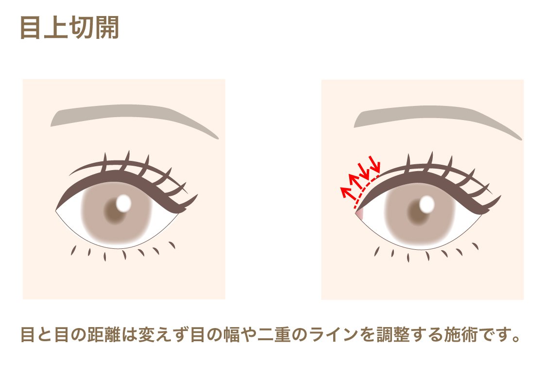 K4Gua's tweet photo. @tara2020san 目上切開は蒙古襞切除の一種になると思います😣
わたしもカウセの時に目頭側を広げたくて相談した先生が目頭側皮膚切除と目上切開は違うという認識だったので💦
確か目頭切開のpark法？と似てるって聞いたことあります！
画像貼っときますね😊✨ https://t.co/50mr5DHiqu