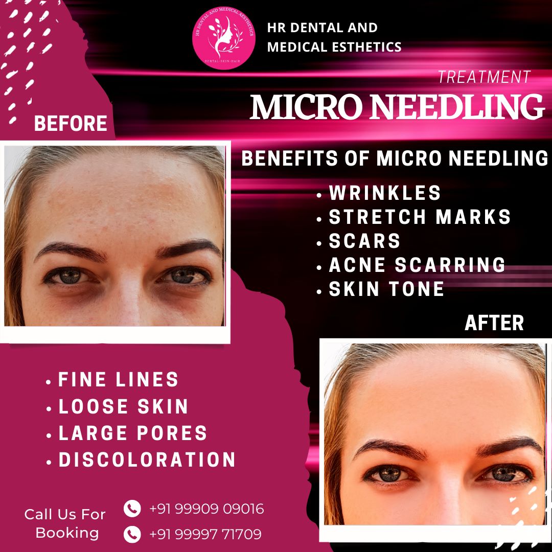 Experience the transformative power of Micro Needling Treatment by HR Dental And Medical Aesthetics!
For bookings, call Dr. Himani Bhardwaj at +91 99997 71709 or visit our clinic at SB 34, Shashtri Nagar, Ghaziabad.
#Microneedling #SkincareGoals #hrdentalcare #skincare #beauty