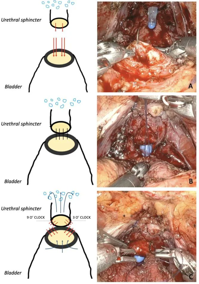 European Urology Open Science (@eururolopen) on Twitter photo Surgery in Motion: Anterior Sphincter-sparing Suturing of the Vesicourethral Anastomosis During Robotic-assisted Laparoscopic Radical Prostatectomy
buff.ly/3P8CKQD
<a href="/AntonelliMD/">Luca Antonelli</a> <a href="/Luca_Afferi/">Luca Afferi</a> <a href="/AgostinoMattei/">Agostino Mattei</a> <a href="/CDFankhauser/">Christian D. Fankhauser</a>
#openscience #openaccess Surgery in Motion: Anterior Sphincter-sparing Suturing of the Vesicourethral Anastomosis During Robotic-assisted Laparoscopic Radical Prostatectomy
buff.ly/3P8CKQD
<a href="/AntonelliMD/">Luca Antonelli</a> <a href="/Luca_Afferi/">Luca Afferi</a> <a href="/AgostinoMattei/">Agostino Mattei</a> <a href="/CDFankhauser/">Christian D. Fankhauser</a>
#openscience #openaccess
