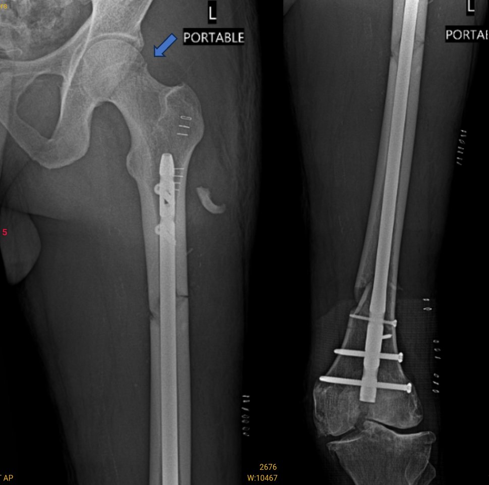 Incidence of Avascular Necrosis of the Femoral Head After Intramedullary  Nailing of Femoral Shaft Fractures: A Multicenter Retrospective Analysis of  542 Cases. - Abstract - Europe PMC