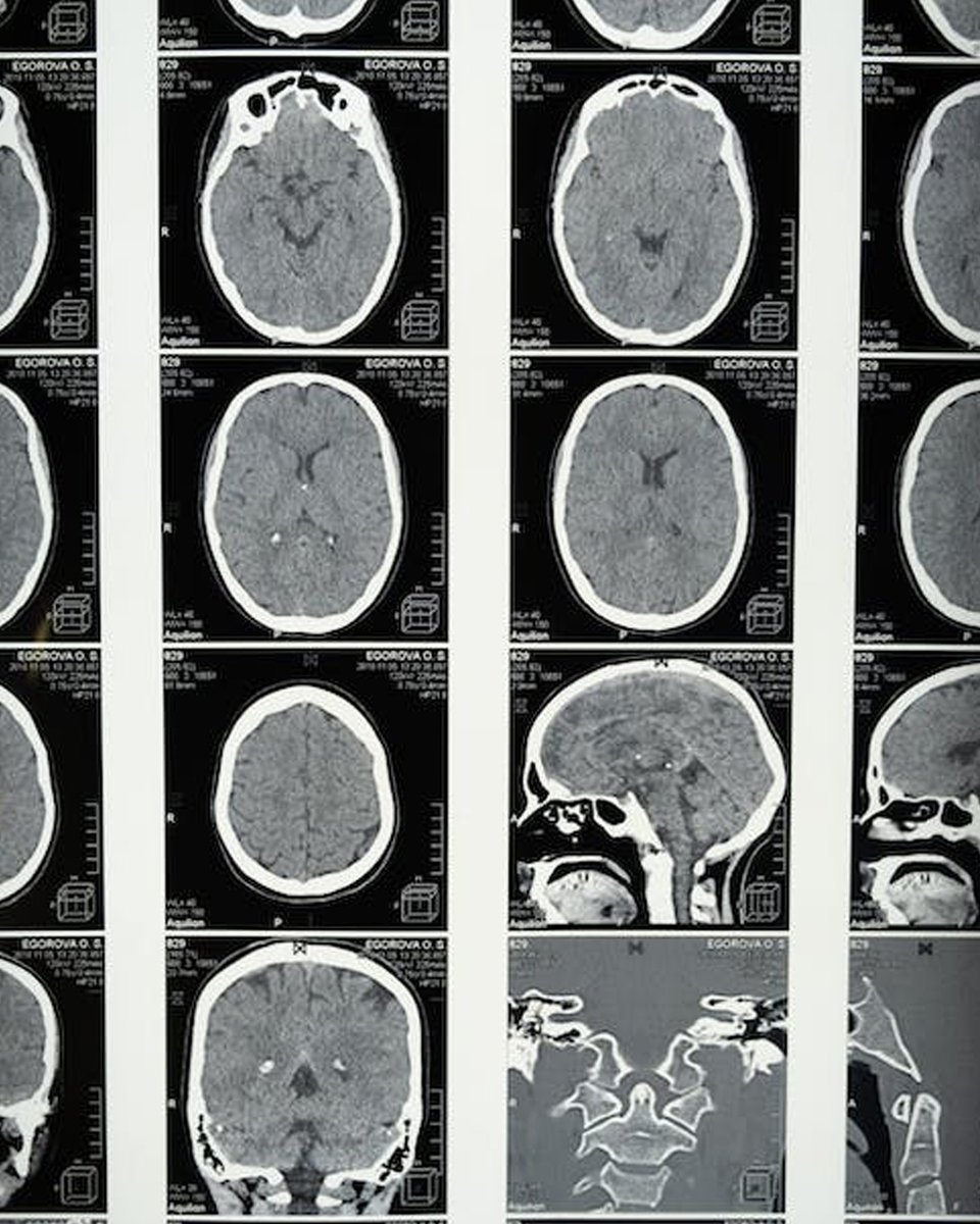 SleepOnGreen's tweet image. The importance of sleep and brain health.

#brain #brainhealth #mentalfunction #importanceofsleep #health #betterhealth #hypoallergenic #green #allnatural #pillow #mattress #sleep #cocofiber #healthyliving #comfortable #natural #ecofriendly #biodegradable #sleepwell #madeinitaly