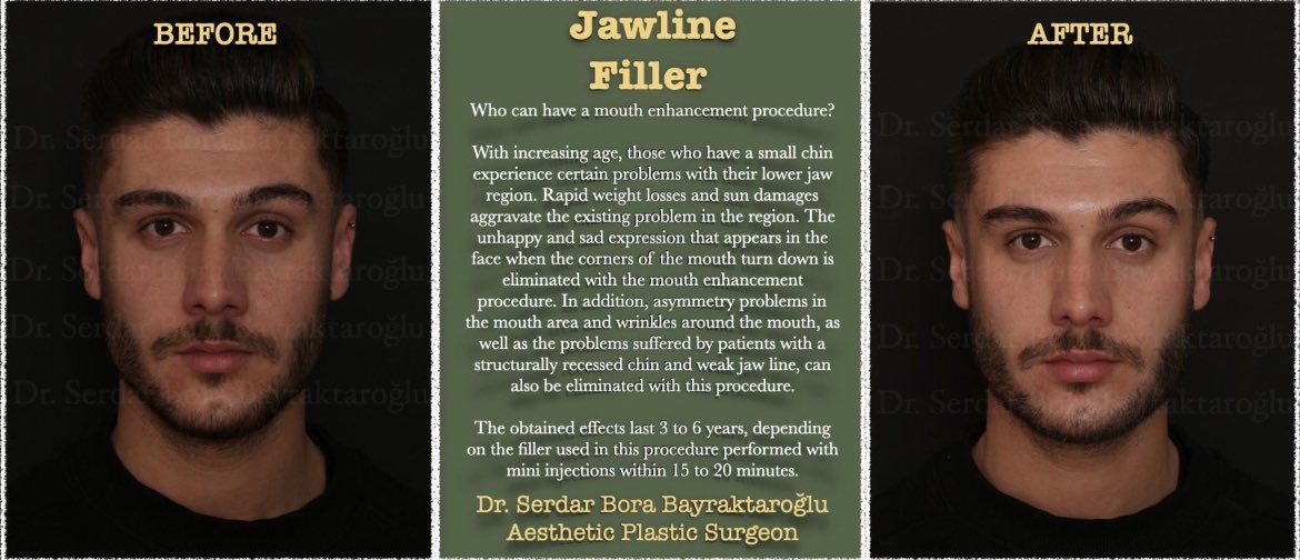 JAWLINE FILLER

#clinicsbb #clinicsbbinternational #aestheticsurgery #plasticsurgery  #plasticsurgeon #serdarborabayraktaroglu #beforeafter #filler #jawline #jawlinefiller #new #aesthetic #manaesthetic #aestheticsurgery