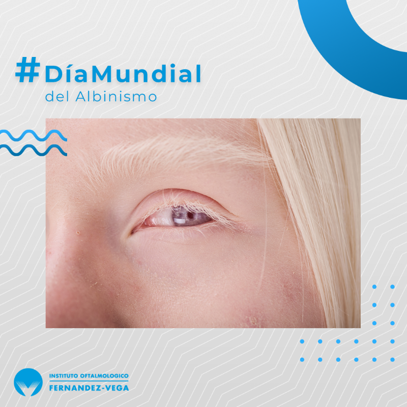 IOFVega's tweet photo. Hoy es el #DíaMundialdelAlbinismo. Según la ONU se estima que en América del Norte y en Europa una de cada 17.000 y 20.000 personas convive con alguna forma de albinismo. ¿Sabías que también afecta a la visión? En nuestro #BlogFV te explicamos en qué consiste 👇