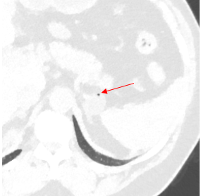 Adrenal nodule?
Tiny speck of air shows up on lung windows (red arrow), confirming this is a gastric fundal diverticulum, likely congenital. 
More common than literature suggests, easily misdiagnosed as adrenal lesion.
#FOAMed #radres