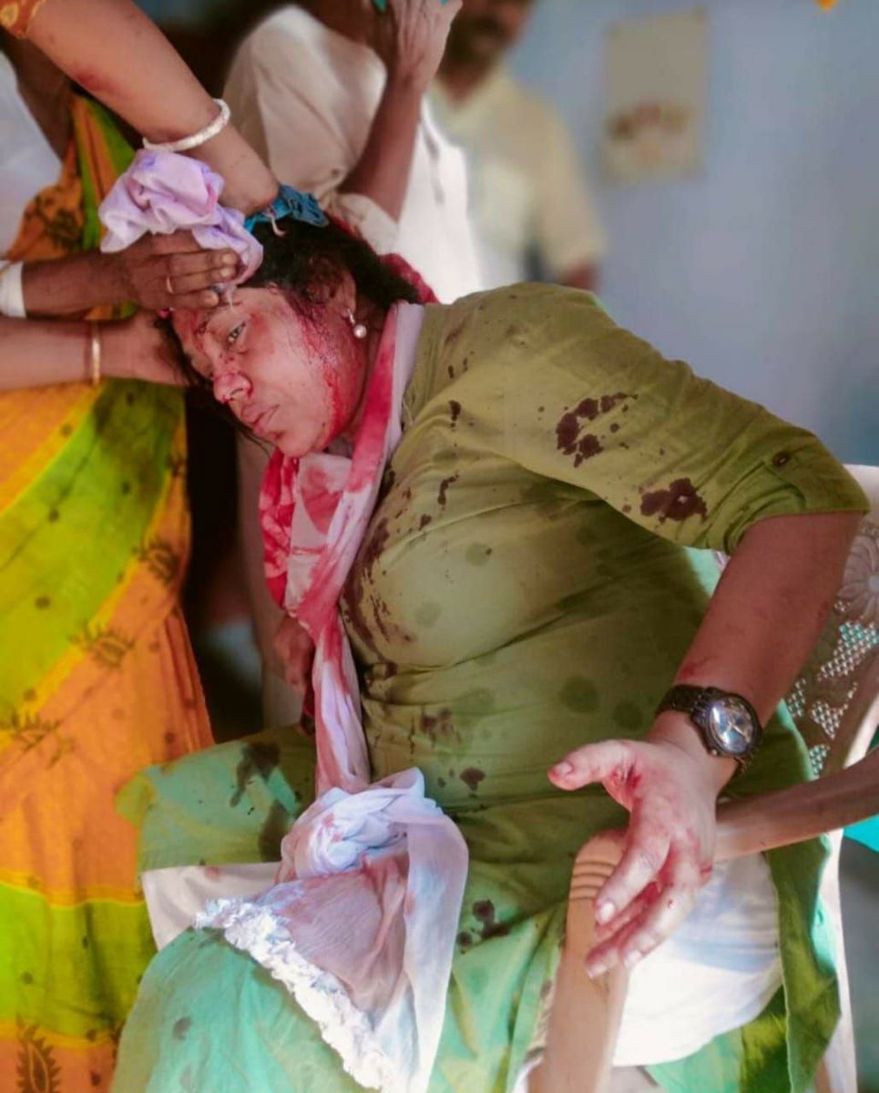 CpimPollachi's tweet image. மேற்கு வங்கத்தில் #AIDWA மத்திய நிர்வாகக்குழு உறுப்பினர் சோமாதாஸ் மீது திரிணமூல் குண்டர்களால் தாக்குதல். பர்காணா மாவட்டத்தில் உள்ளாட்சித் தேர்தல்களில் மனுதாக்கல் செய்ய தயாரிப்பு வேலைகளில் இருந்தபோது மணிக் கணக்கில் கொலைவெறி தாக்குதல். பலர் காயம். திரிணமூல் தோல்வி பயம்! #TMCTerror