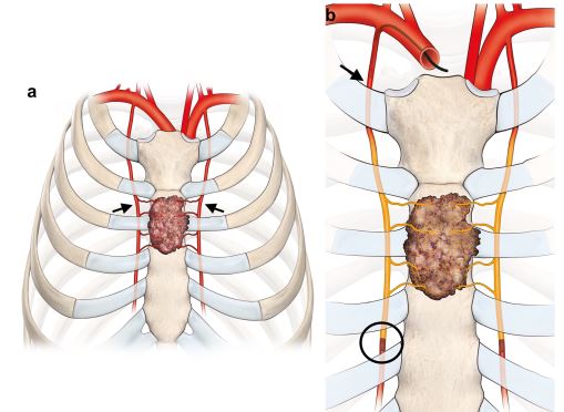 Check out this recently published #shortcommunication 👇
Palliative Arterial #Embolization for #Metastases of the #Sternum
link.springer.com/article/10.100…