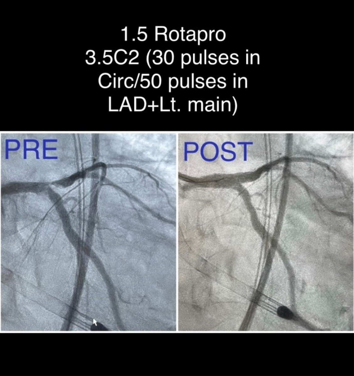 A TopShock-worthy #RotaShock case by Dr. Boshra Louka <a href="/Boshra3Agban/">Boshra Louka MD, FACC, FASCI</a> using 1.5 rota &amp; 80 pulses #ShockwaveC2 to treat a CN in the LM &amp; LCX for a fantastic result.

Make sure to submit your best nodular/eccentric case by June 15! discover.shockwavemedical.com/topshock

ISI bit.ly/3iEq7fC