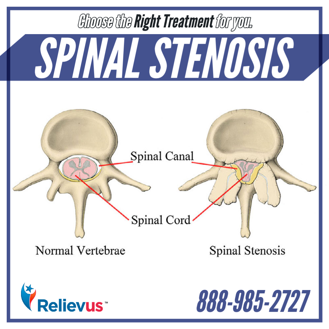 Relievus's tweet image. Are you suffering from #backpain or #backproblem? It could be #spinalstenosis or #stenosis. Don&apos;t let it take control of your life, get relief and #feelbetter now! Learn more about #spineinjury at relievus.com/conditionsands… 
888-985-2727

#painrelief #relievus #relievepain