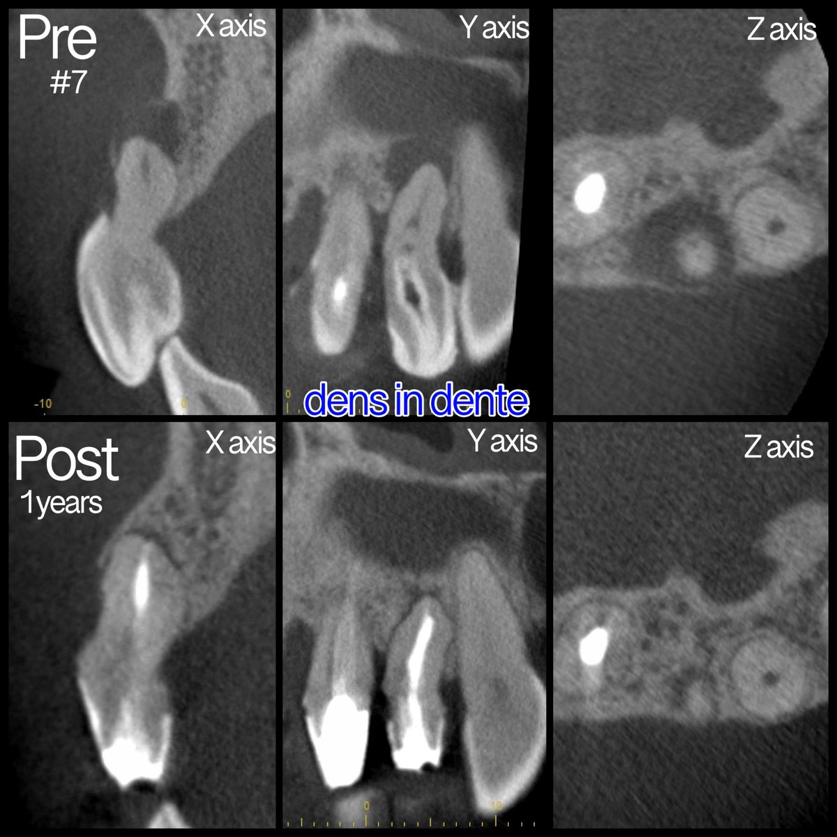 保険治療でも抜かずに治せる制度になることを望みます。

#歯医者 #歯　#endodontics #dentist  #dentista  #rootcanaltreatment  #dentalstudent  #endodontist  #歯科  #dentalhygienist  #イリタニオフィス　#歯科衛生士 #根管治療  #歯医者  #endodoncia #saveteeth #endodontia #radiologista